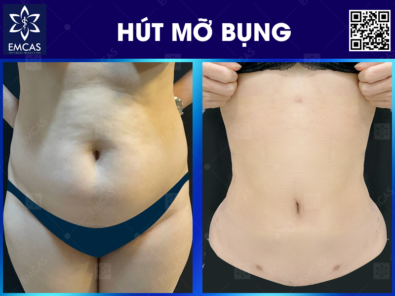 Những Điều Cần Biết Khi Hút Mỡ Bụng