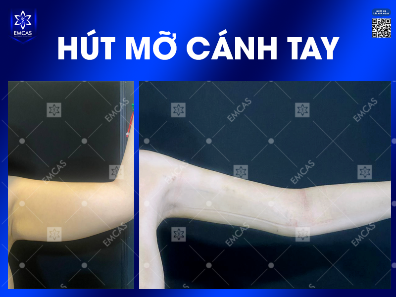 5 Lợi Ích Khi Chọn Hút Mỡ