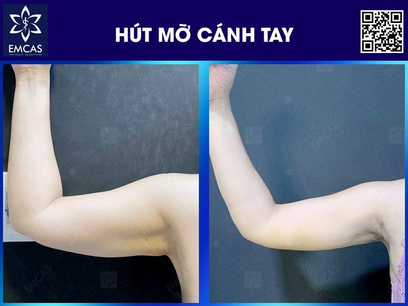 HÚT MỠ CÁNH TAY