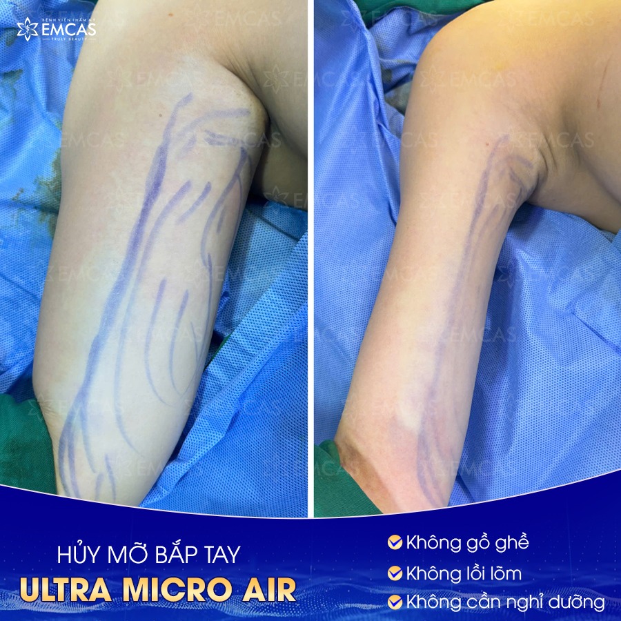 Tìm Hiểu Kỹ Hơn Về Các Dịch Vụ Hút Mỡ Hiện Nay
