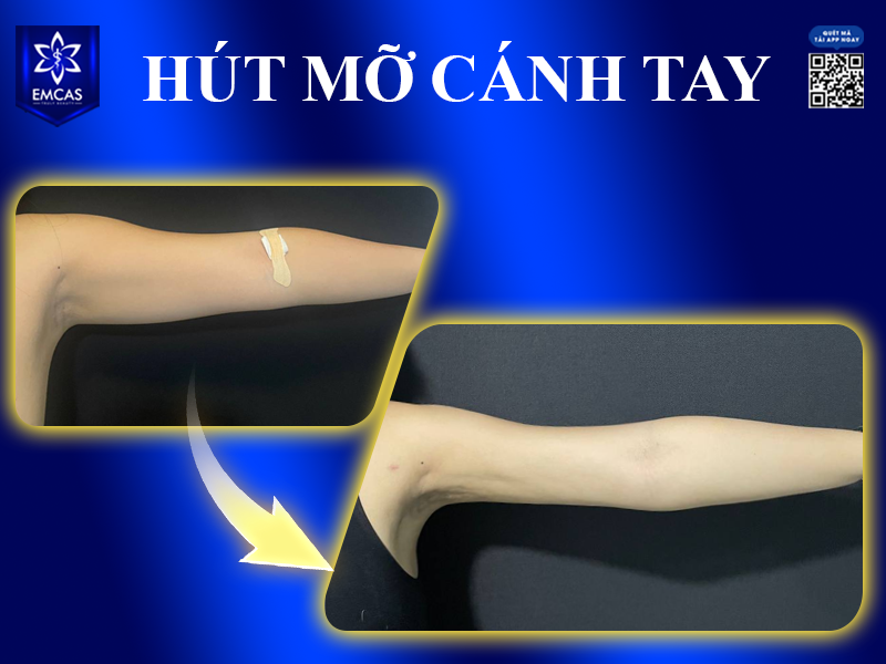 Nên Hút Mỡ Bụng, Đùi, Cánh Tay Hay Nọng Cằm Trước?
