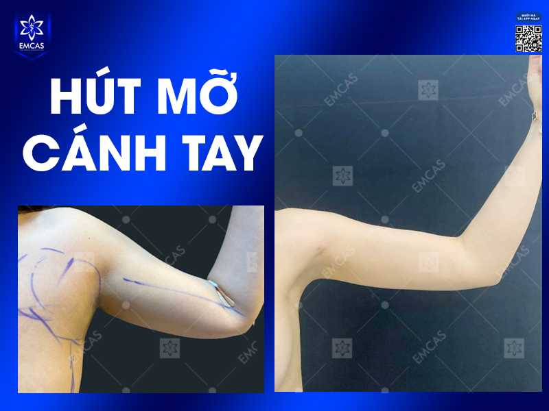 Hút Mỡ Cánh Tay - Giải Pháp Hiệu Quả Cho Đôi Tay Thon Gọn