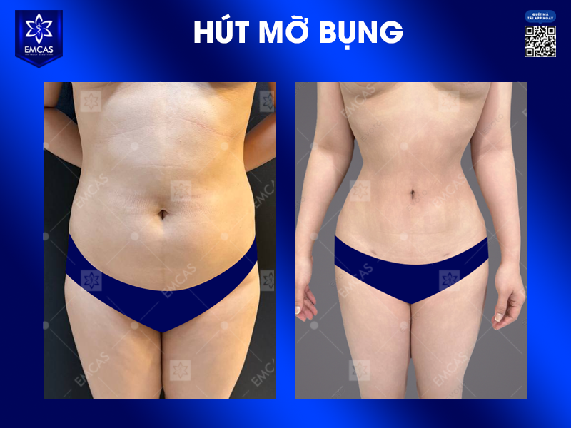 5 Lợi Ích Khi Chọn Hút Mỡ