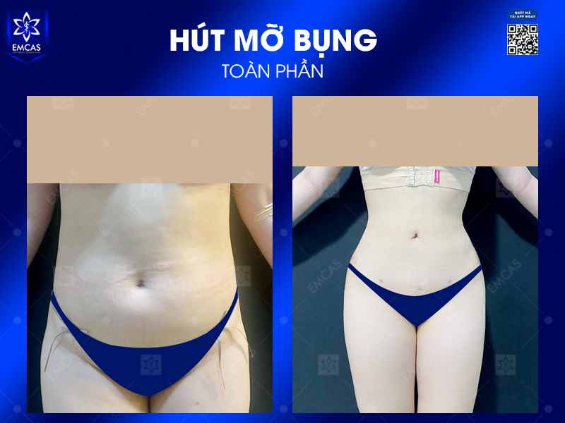 5 Lợi Ích Khi Chọn Hút Mỡ