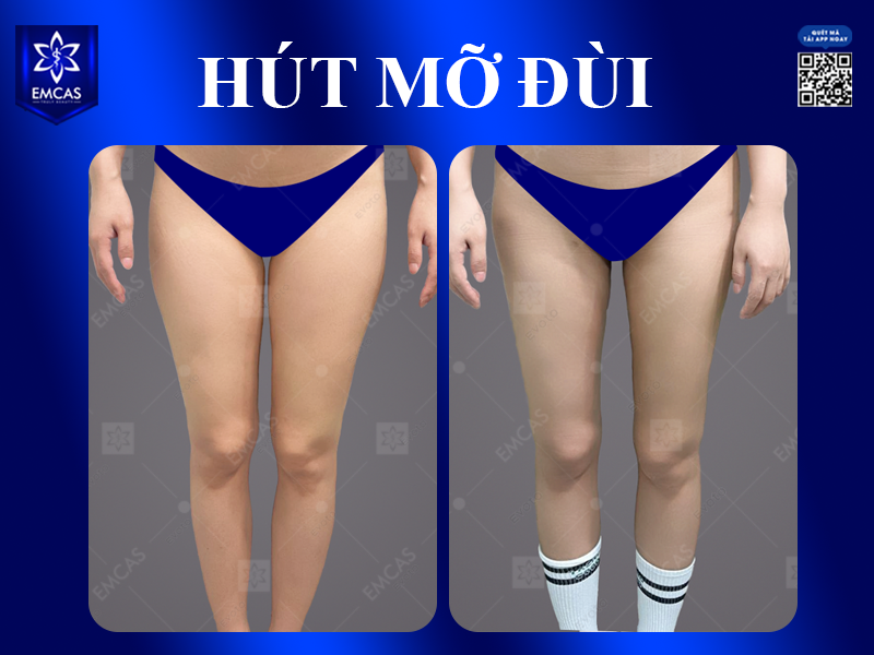 Nên Hút Mỡ Bụng, Đùi, Cánh Tay Hay Nọng Cằm Trước?