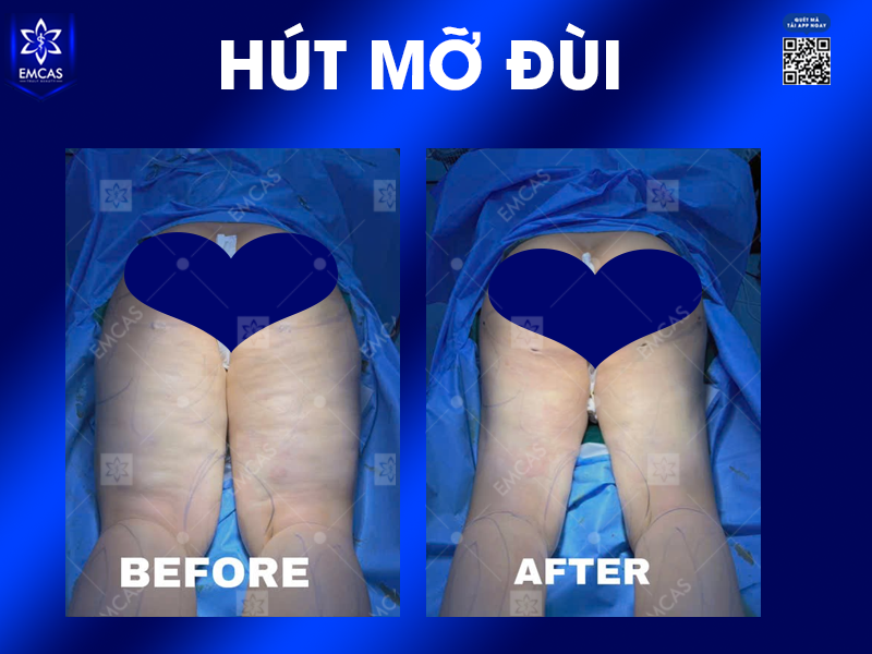 Hút Mỡ Đùi Có Giúp Đôi Chân Thon Gọn Không?
