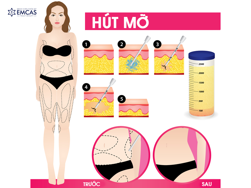 HÚT MỠ HÔNG EO