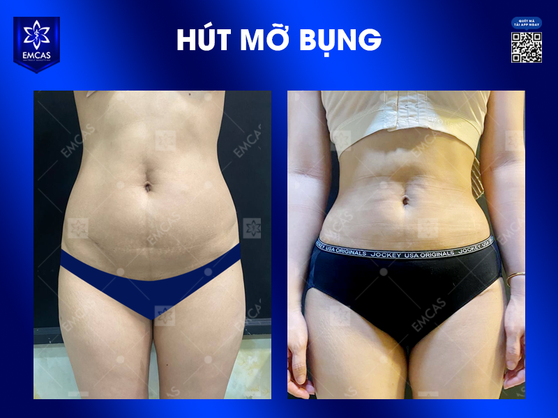 Hút Mỡ Nam Giới Có Gì Khác Với Nữ