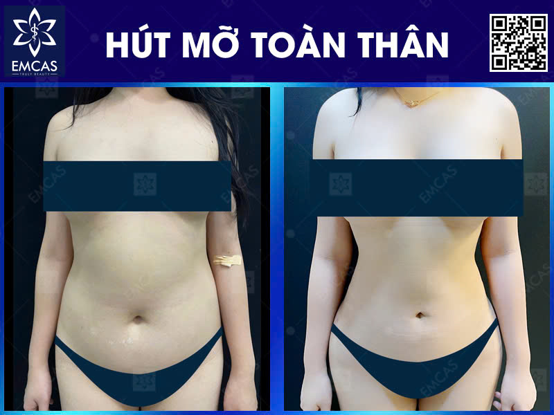 5 Lợi Ích Khi Chọn Hút Mỡ