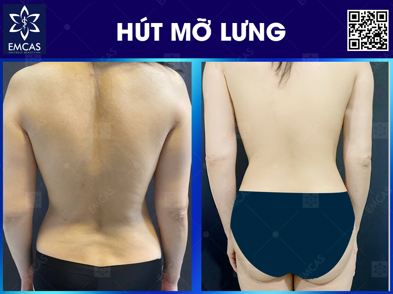 Tìm Hiểu Kỹ Hơn Về Các Dịch Vụ Hút Mỡ Hiện Nay