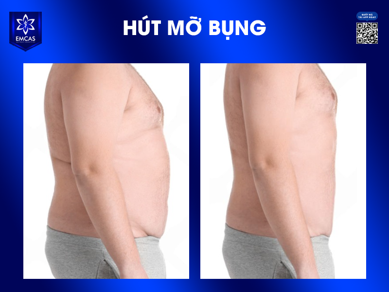 Hút Mỡ Nam Giới Có Gì Khác Với Nữ