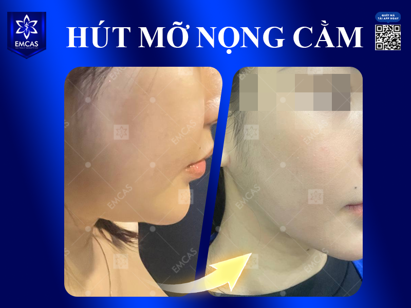 Nên Hút Mỡ Bụng, Đùi, Cánh Tay Hay Nọng Cằm Trước?