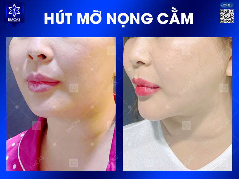 Hút Mỡ Nọng Cằm - Phương Pháp Làm Thon Gọn Khuôn Mặt Nhanh Chóng