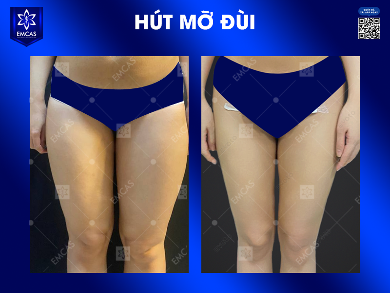5 Lợi Ích Khi Chọn Hút Mỡ
