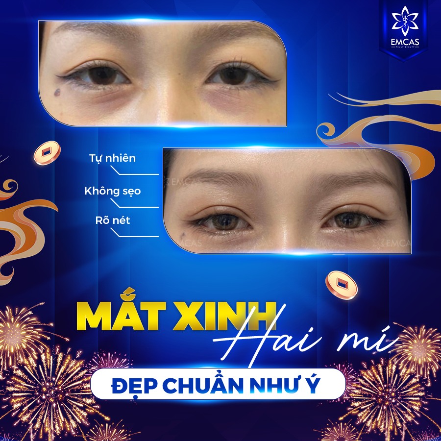 Phương Pháp Cắt Mí Mắt Hiện Đại: An Toàn, Hiệu Quả Và Không Đau Đớn