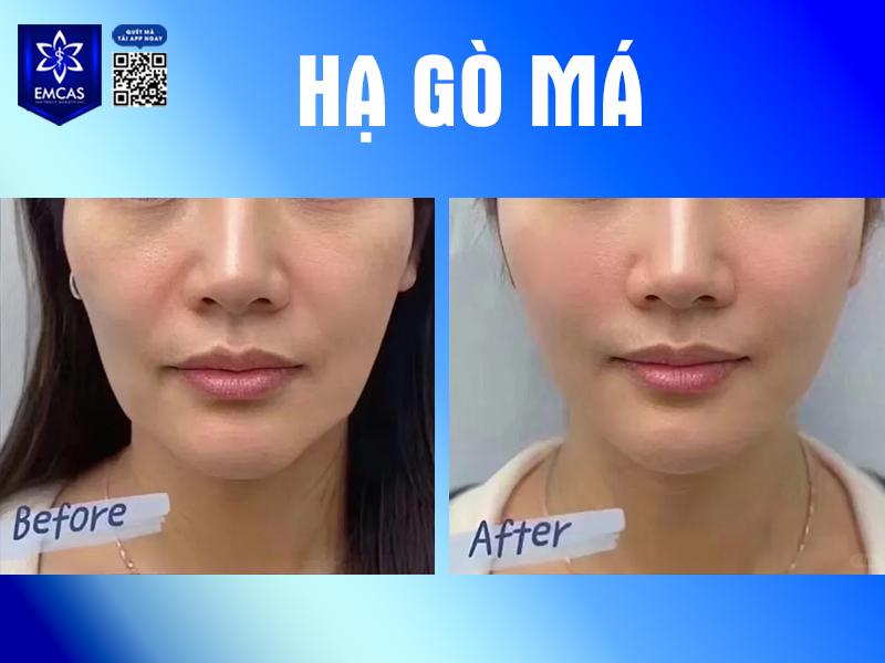Gò Má Cao Có Xấu Không? Khi Nào Cần Hạ Gò Má?