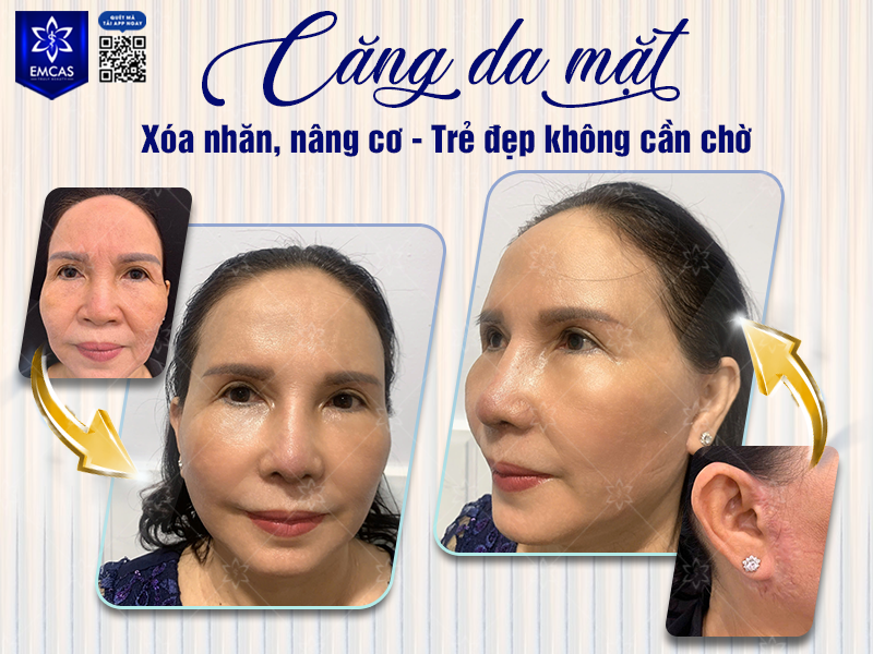 Làm Thế Nào Để Giúp Kéo Dài Hiệu Quả Căng Da Mặt?