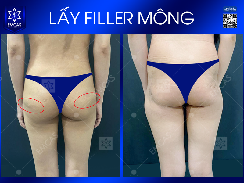 Một Số Phương Pháp Nâng Mông Phổ Biến Hiện Nay