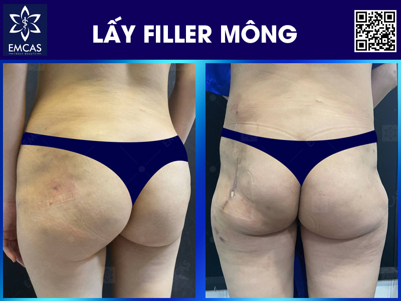 LẤY FILLER VÙNG MÔNG