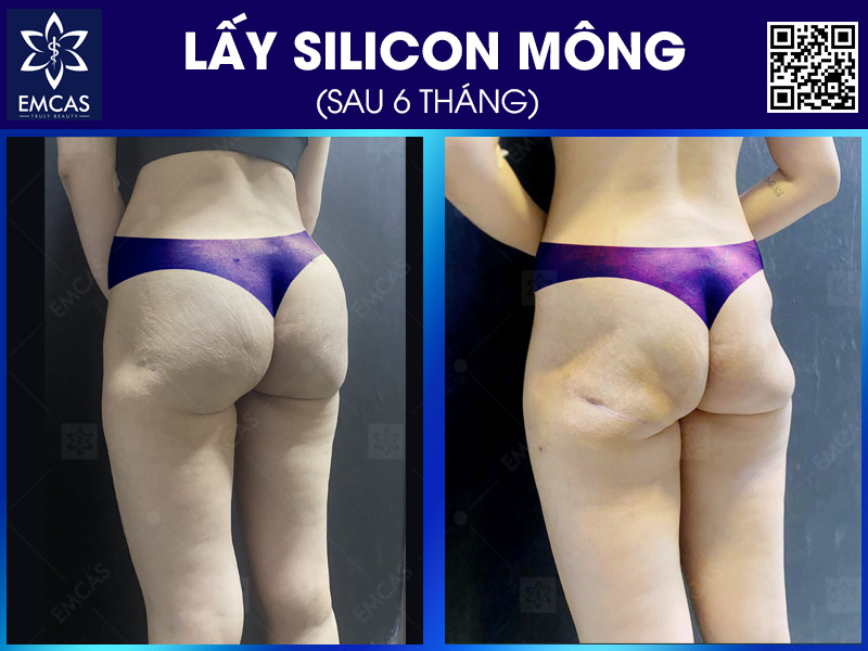 LẤY SILICON VÀ TÁI TẠO MÔNG