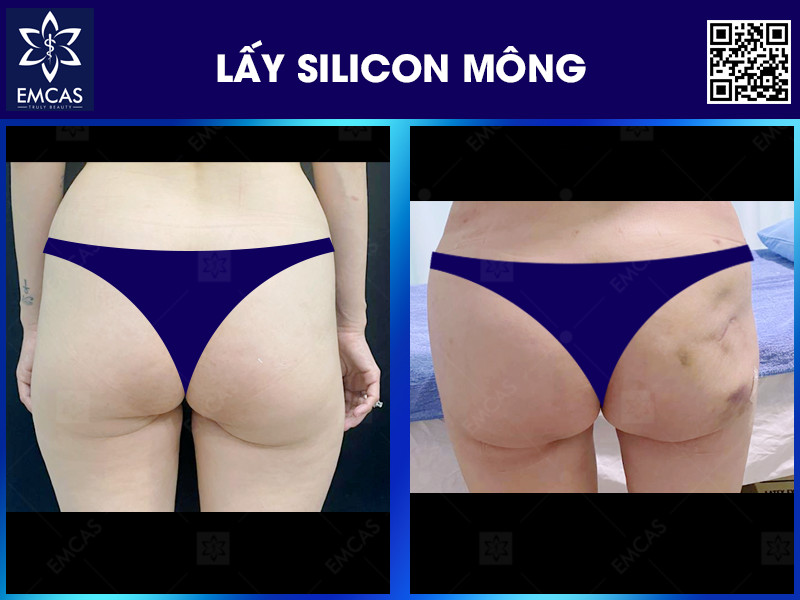 LẤY SILICON VÀ TÁI TẠO MÔNG