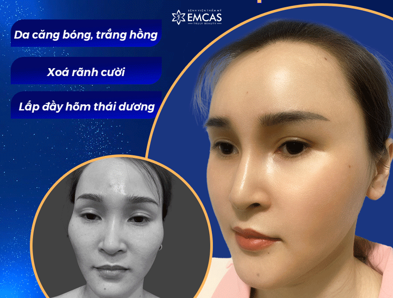 Review Cấy Mỡ Tự Thân Lên Mặt - Kinh Nghiệm Thực Tế