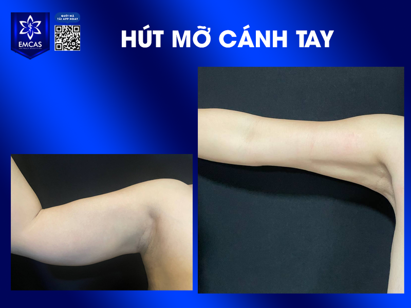Hút Mỡ Bắp Tay - Phương Pháp Giúp Cánh Tay Săn Chắc, Không Chảy Xệ