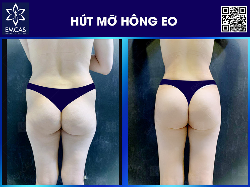 Hút mỡ hông eo