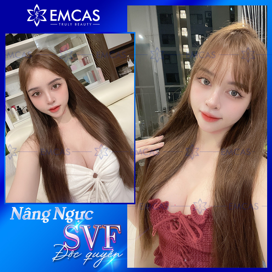 Lợi Ích Của Nâng Ngực SVF