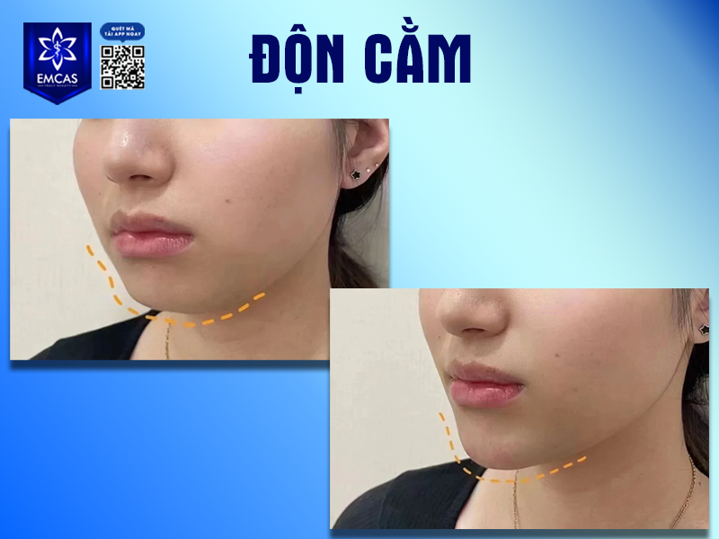 Những Yếu Tố Ảnh Hưởng Đến Kết Quả Độn Cằm