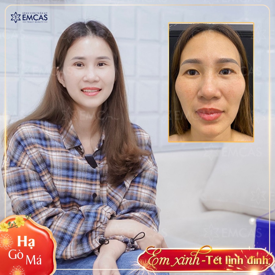 HẠ XƯƠNG GÒ MÁ