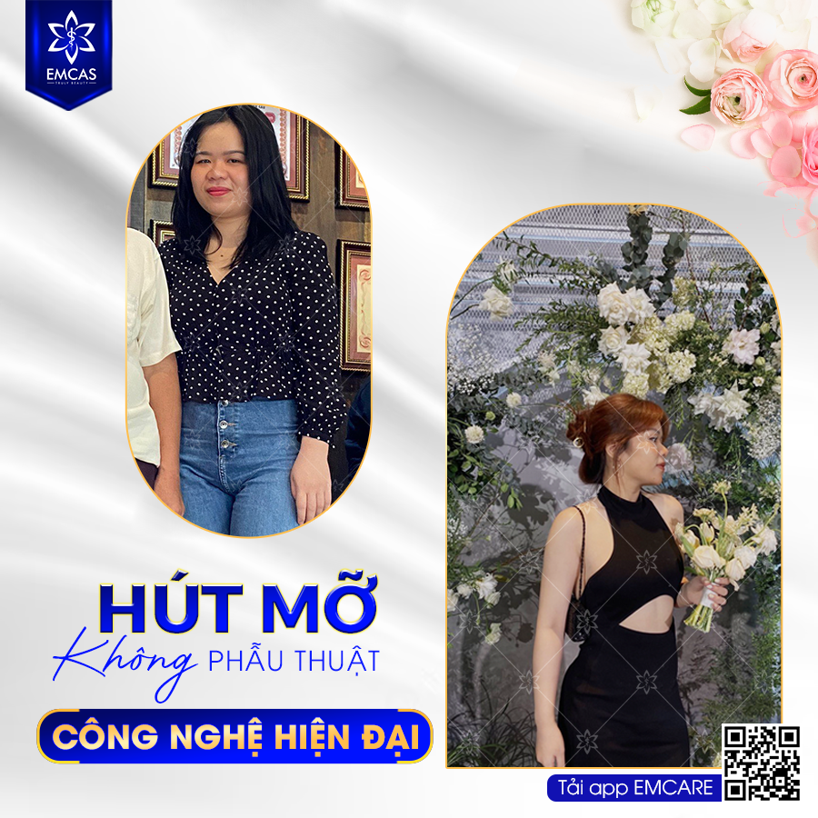 HÚT MỠ BỤNG