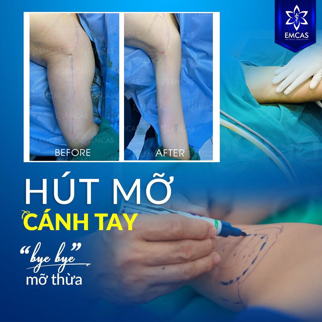 HÚT MỠ CÁNH TAY
