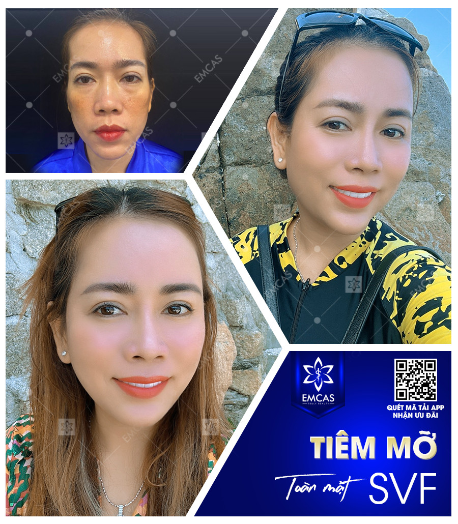 Lợi Ích Của Phương Pháp Tiêm Mỡ Toàn Mặt Là Gì?