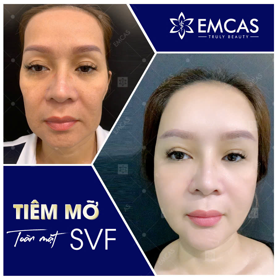 TIÊM MỠ TOÀN MẶT - SVF