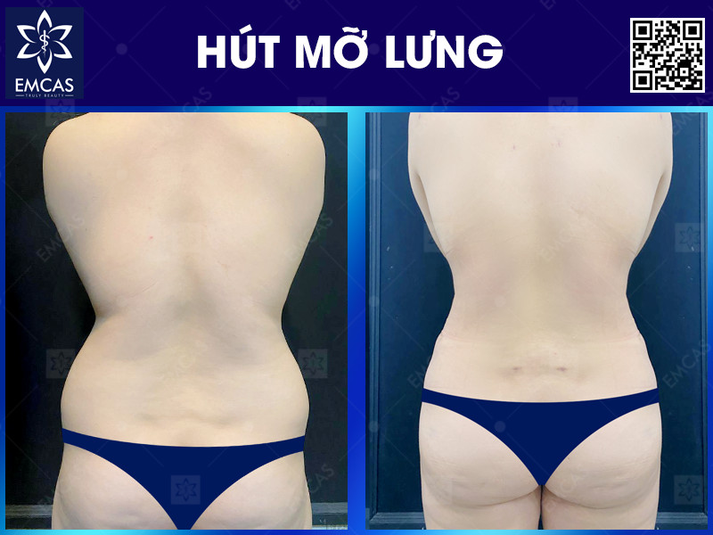 HÚT MỠ LƯNG