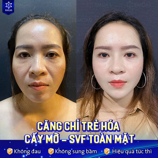 Cấy Chỉ Nâng Cơ, Căng Da Không Phẫu Thuật