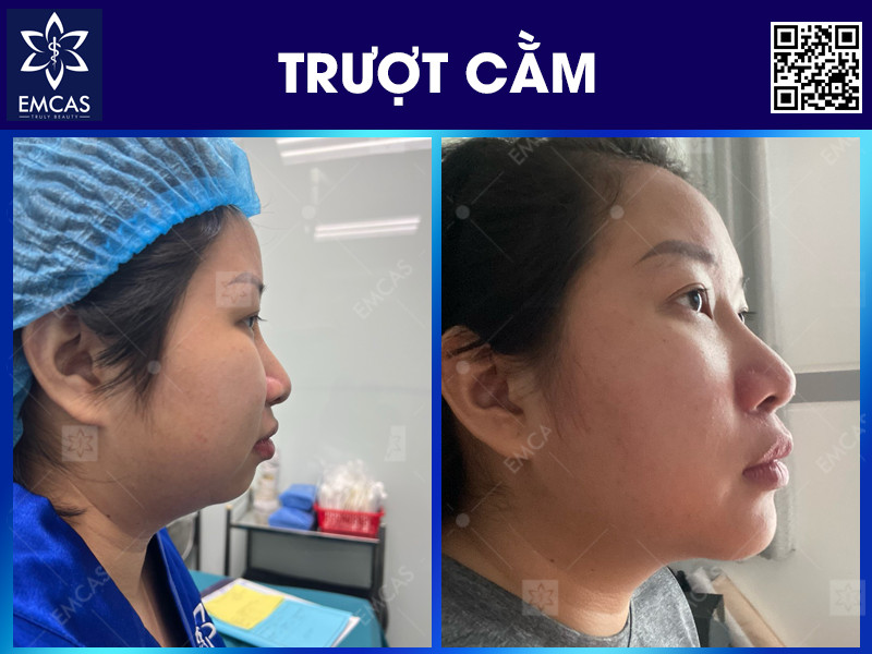 Trượt Cằm Và Những Điều Cần Biết