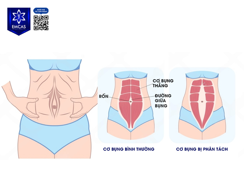 Lấy Lại Vòng 2 Thon Gọn Sau Sinh Nhờ Tái Tạo Thành Bụng