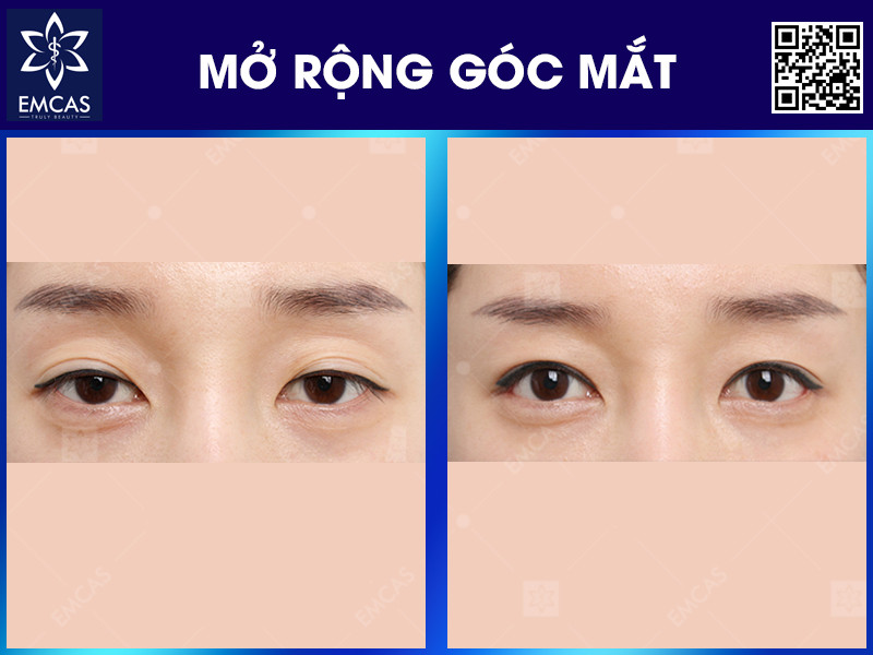 Mở rộng góc mắt