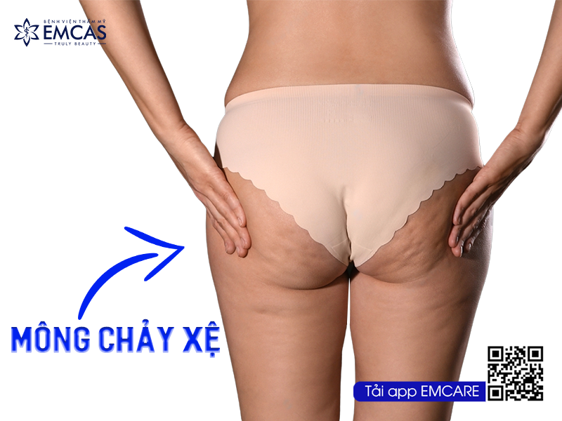 Tìm Hiểu Thêm Về Phương Pháp Nâng Mông Chảy Xệ