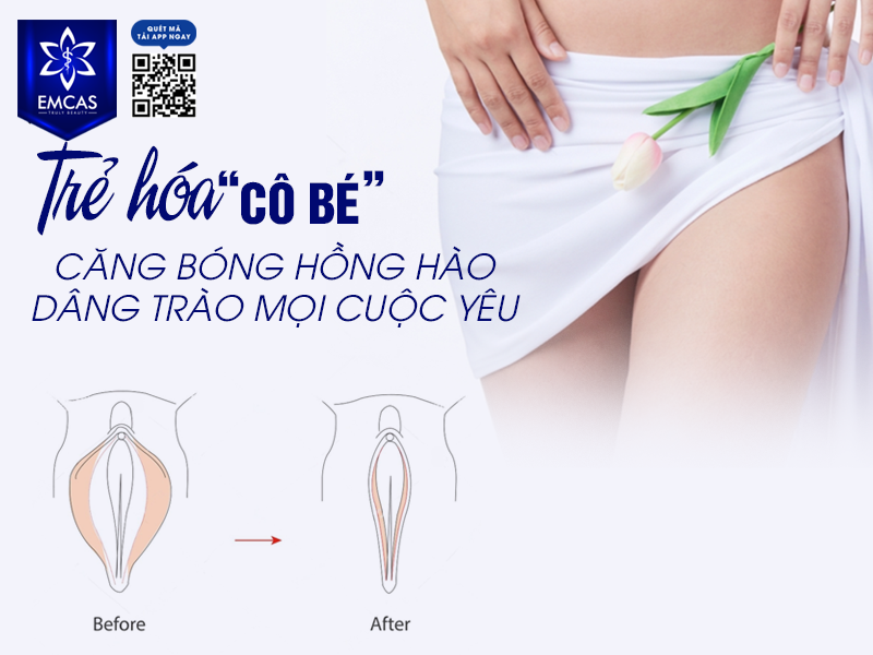 Một Số Lưu Ý Sau Khi Thẩm Mỹ Tầng Sinh Môn