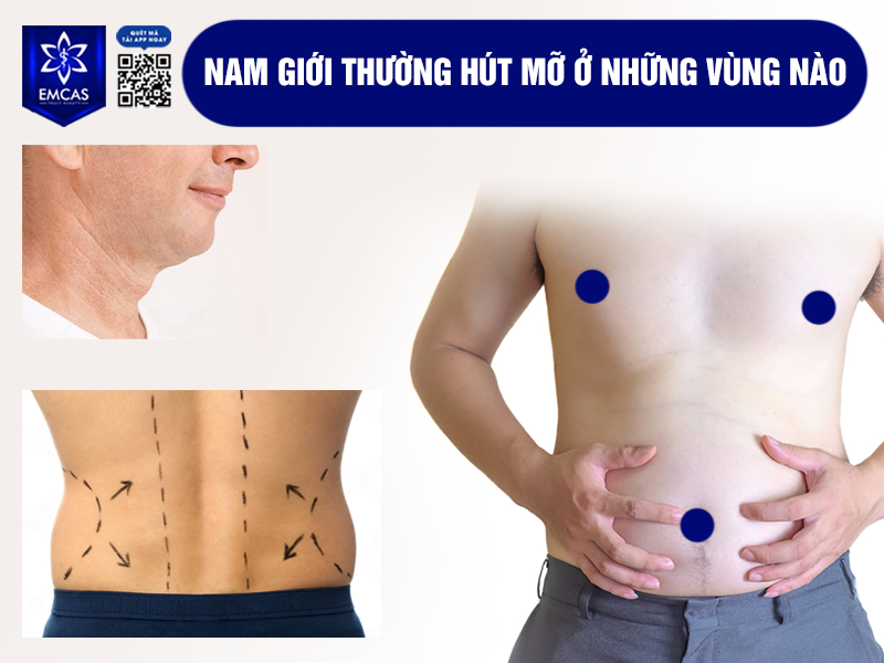 Hút Mỡ Nam Giới Có Gì Khác Với Nữ