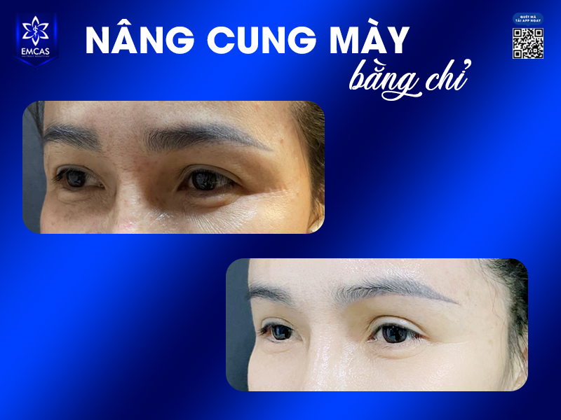Nâng Cung Chân Mày Có Tác Dụng Gì?