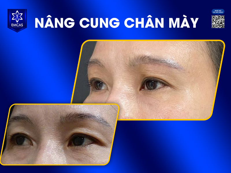 Nâng Cung Chân Mày Là Gì?