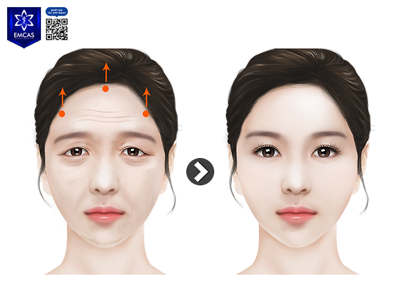 Nâng Cung Chân Mày Có Tác Dụng Gì?