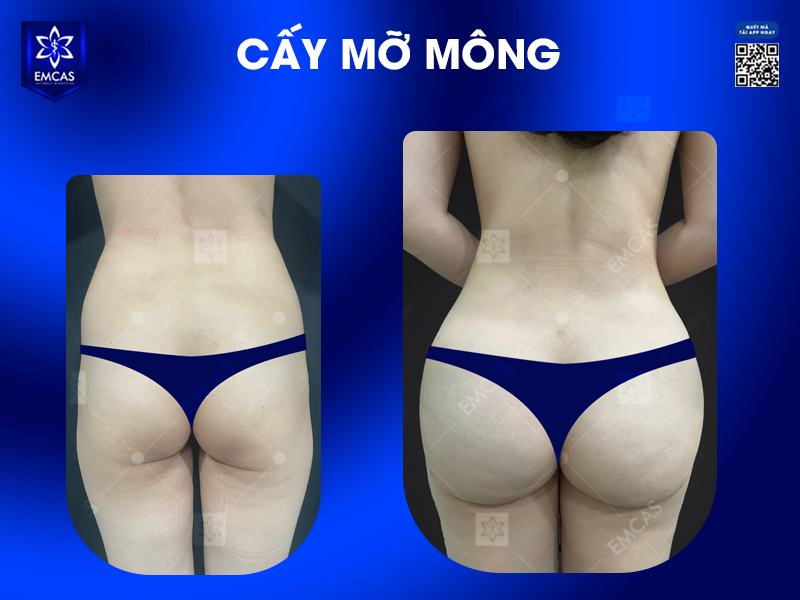 Sau Khi Nâng Mông Có Bị Chảy Xệ Không? Cách Duy Trì Vòng 3 Săn Chắc