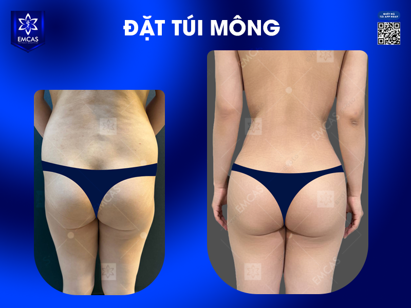 Nâng Mông Có Ảnh Hưởng Đến Việc Ngồi Hay Đi Lại Không?