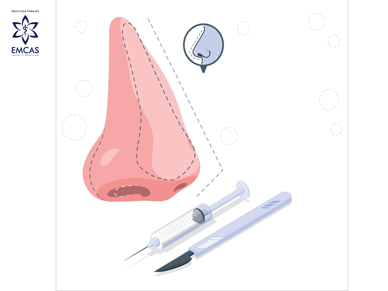 Xem Xét Việc Nâng Mũi Bán Cấu Trúc - Quyết Định Thông Thái