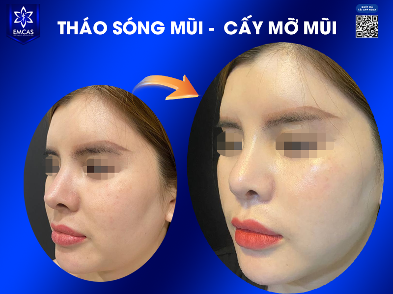 Lựa Chọn Nào Cho Người Nâng Mũi Lần 2?